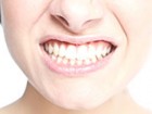 BRUXISM TOOTH THERAPIES